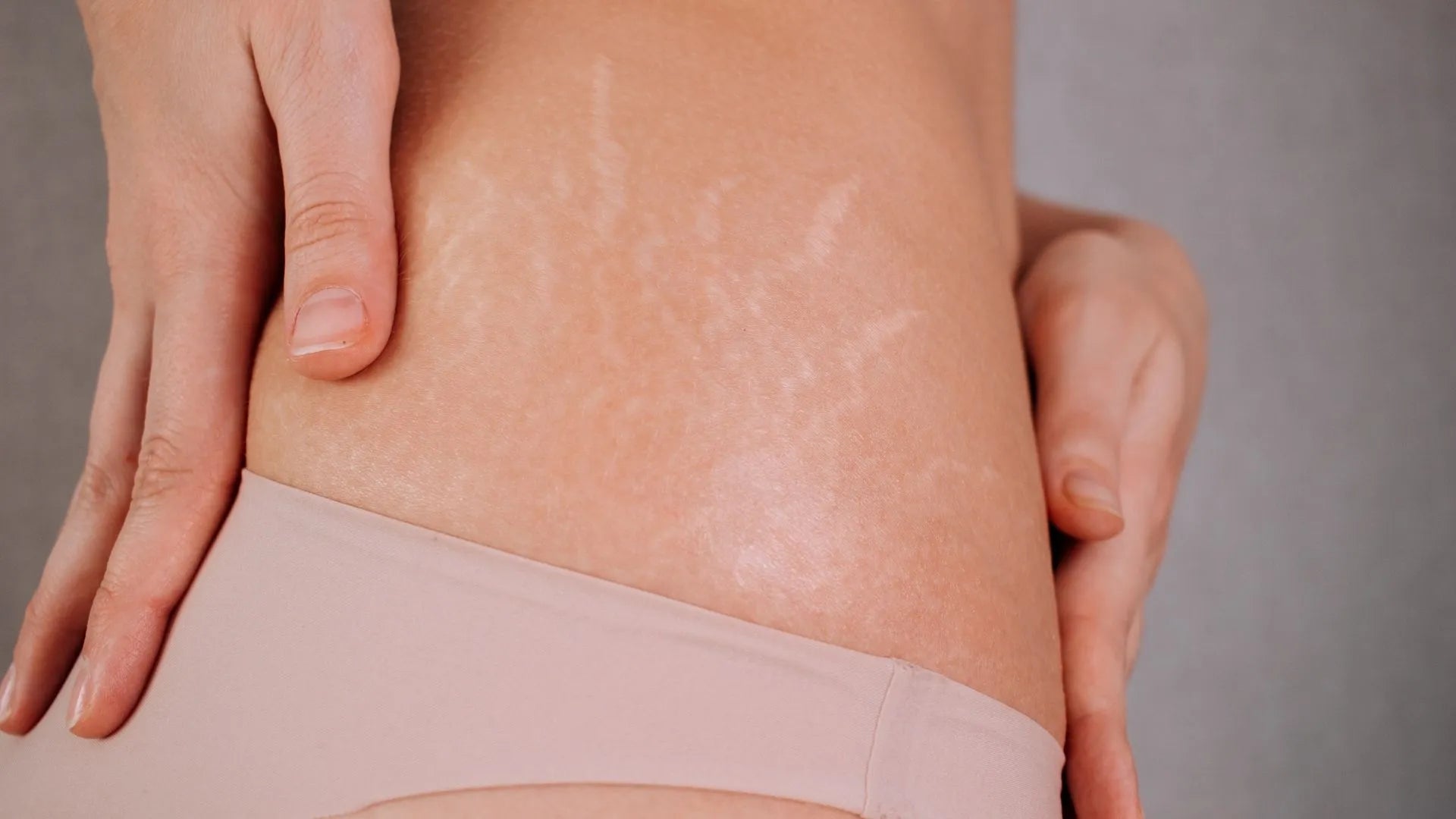 Glycolic Acid Peel: Effective Treatment for Acne Scars, Stretch Marks, and More
