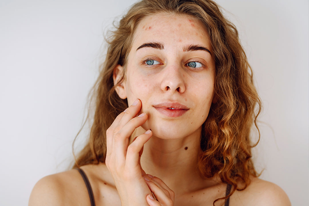 Why Acne-prone Skin Still Needs Moisture
