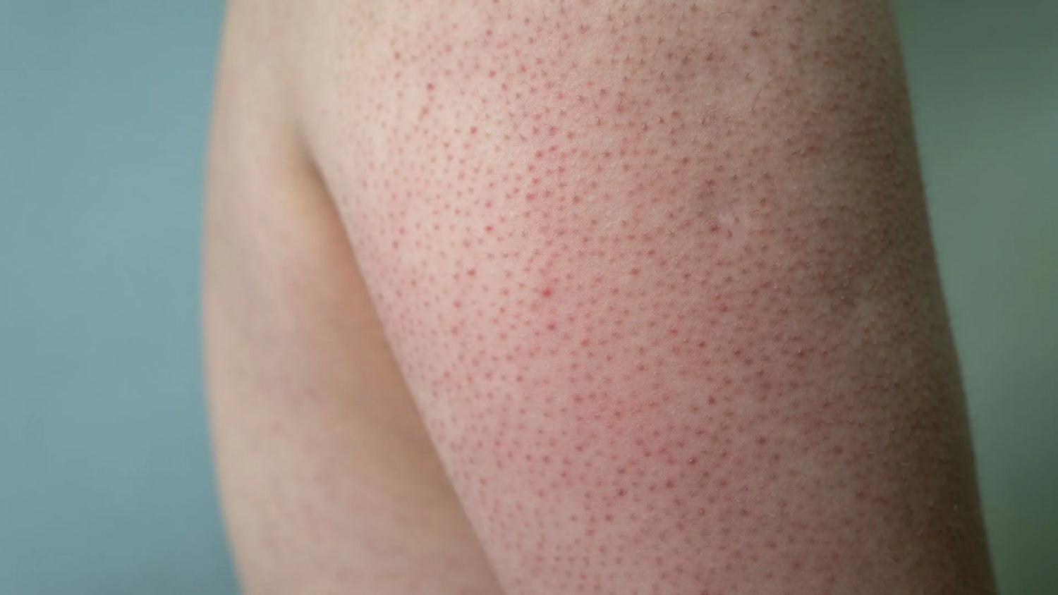 Comprehensive Approach to Treating and Managing Keratosis Pilaris