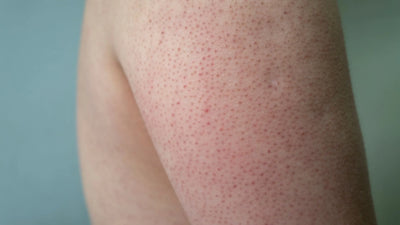 The Ultimate Guide to Treating and Managing Keratosis Pilaris