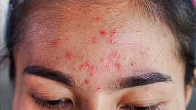 Causes and Remedies for Itchy Forehead: Everything You Need to Know