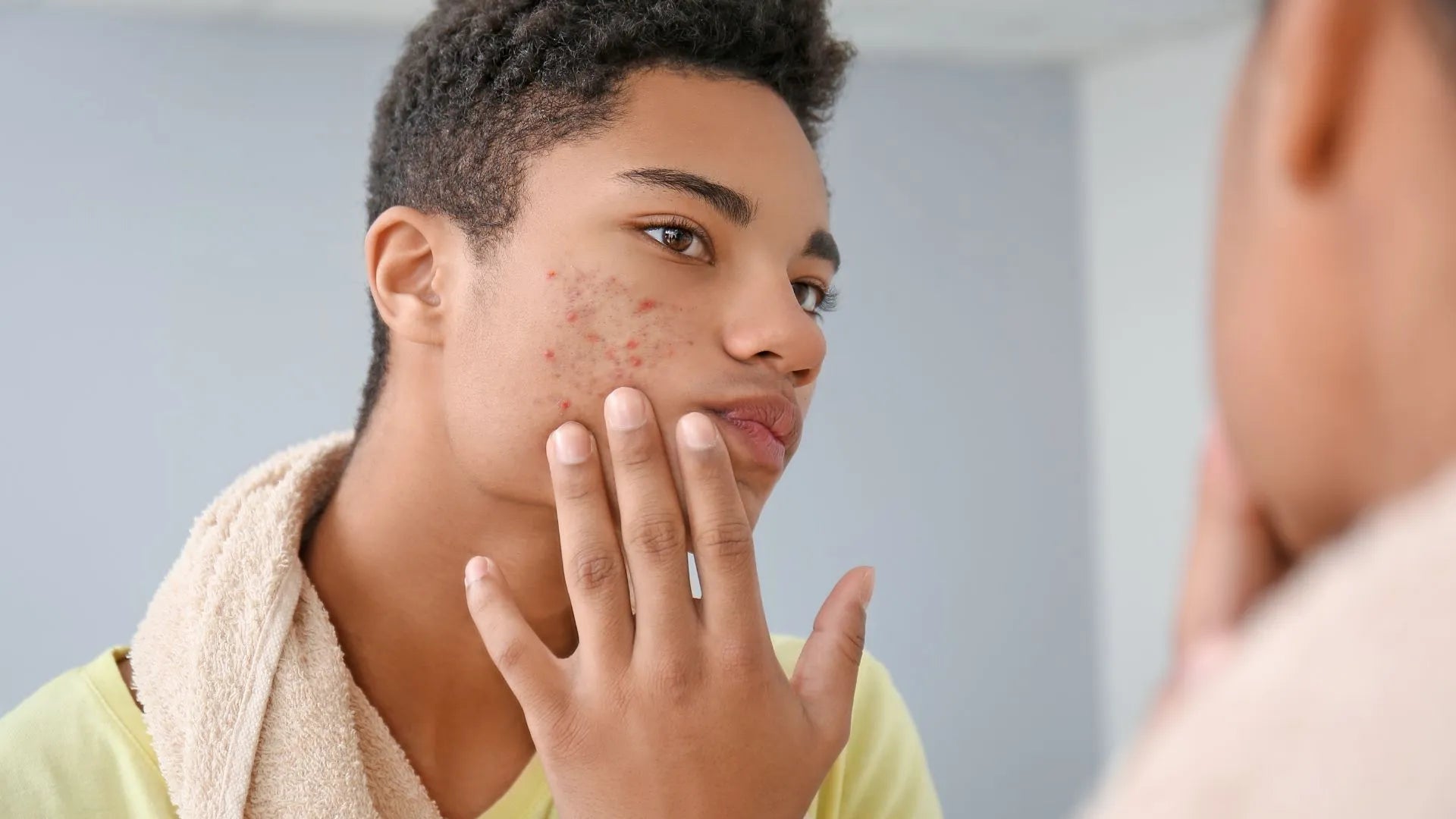 Acne Scarred Pores: Types, Treatment, and Self-Care Guide