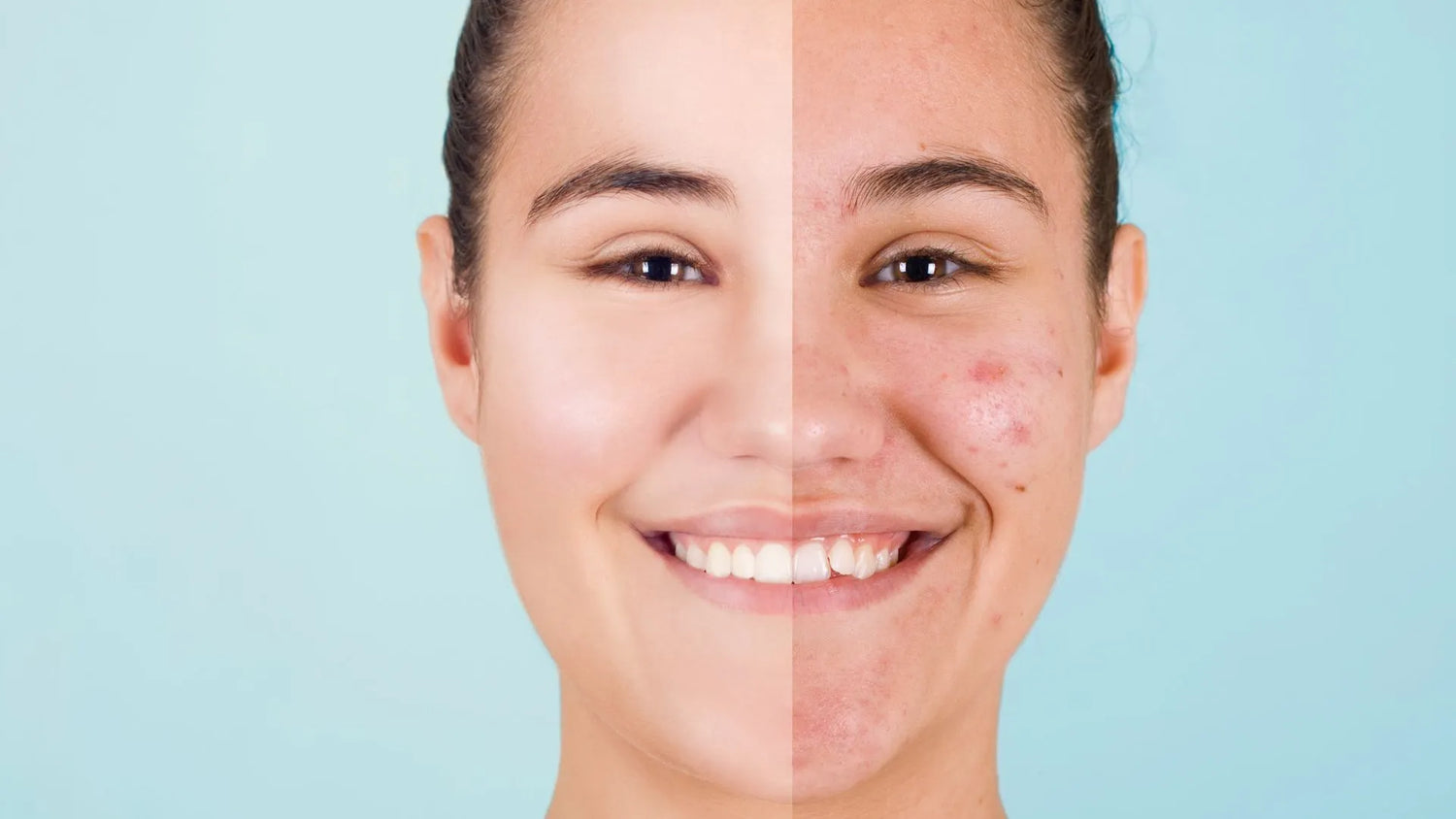 Skin Purging: Debunking Acne Breakouts from Retinol Usage