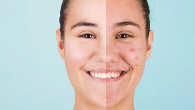 Can Retinol Cause Acne Before and After: Understanding Skin Purging