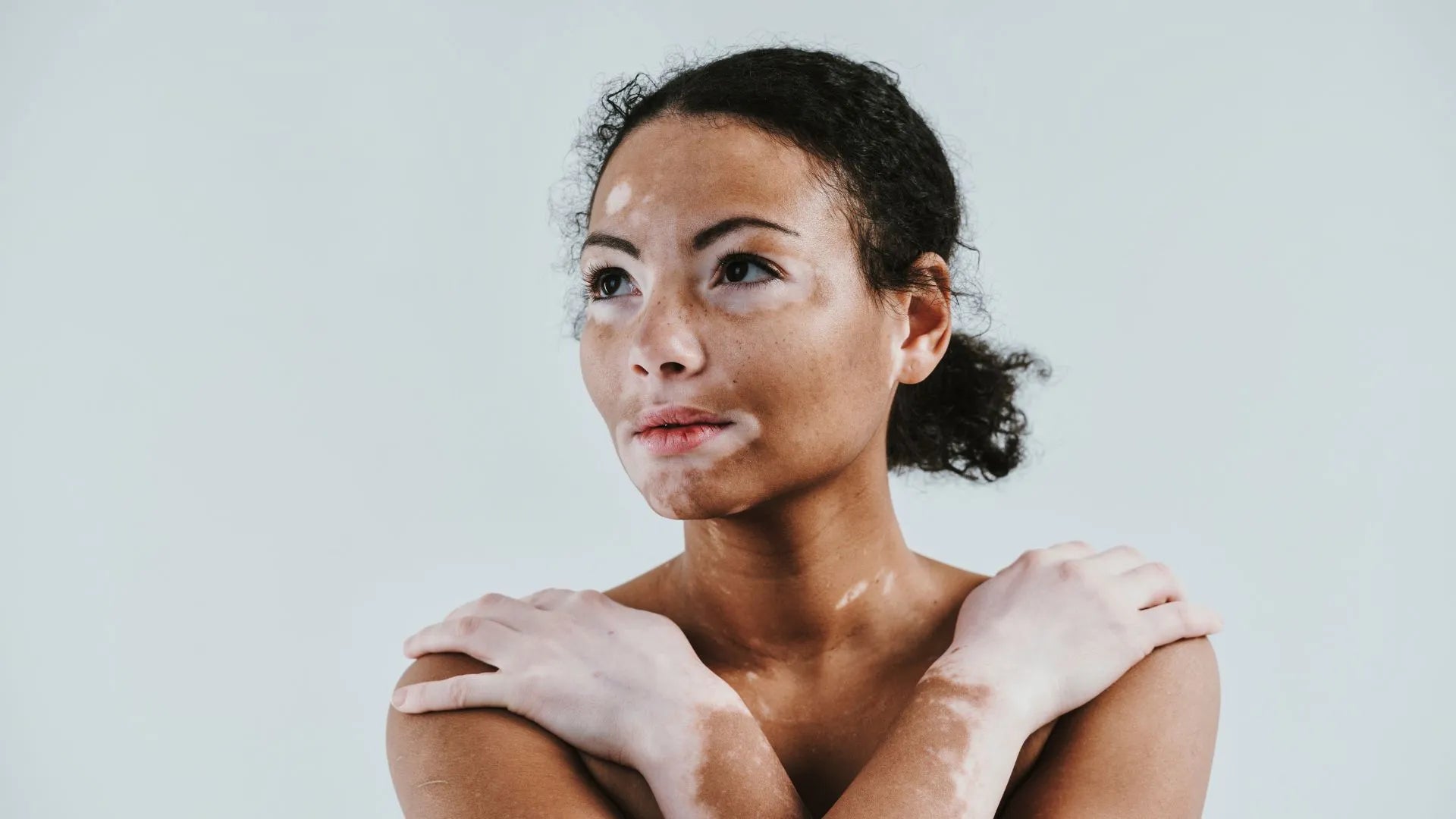 Exploring Hypopigmentation: Causes, Symptoms, and Treatment