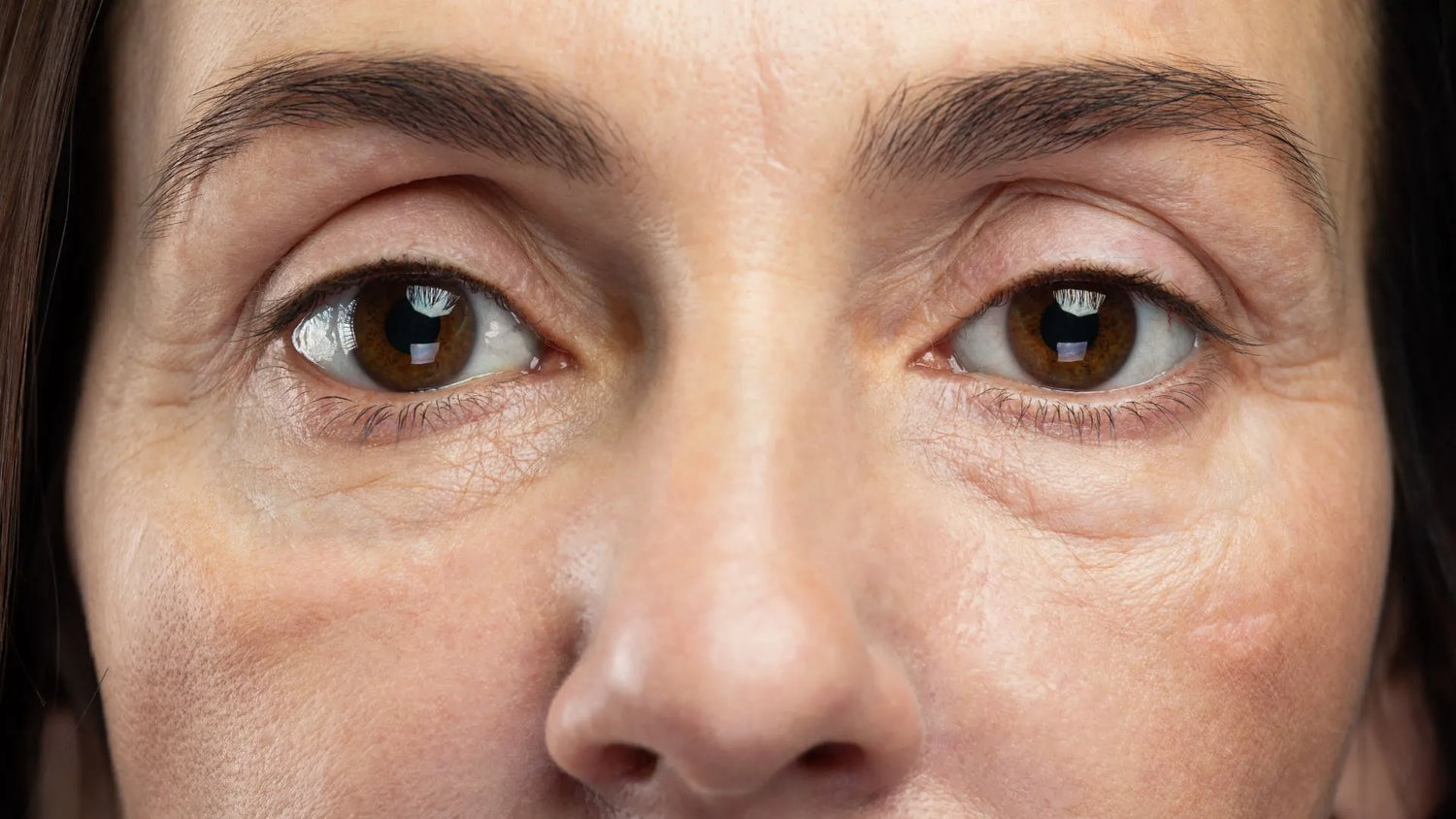 Comparing the effectiveness of Retinol and Hyaluronic Acid for reducing eye bags