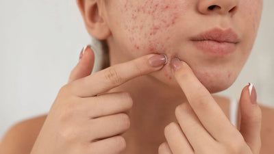Causes, Treatment, and Prevention of Dry Skin Breakout Around the Mouth