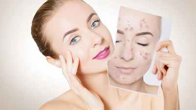 Cure Acne Through Diet: A Comprehensive Guide to Clear Skin