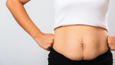 Can You Lose 100 Pounds Without Loose Skin?