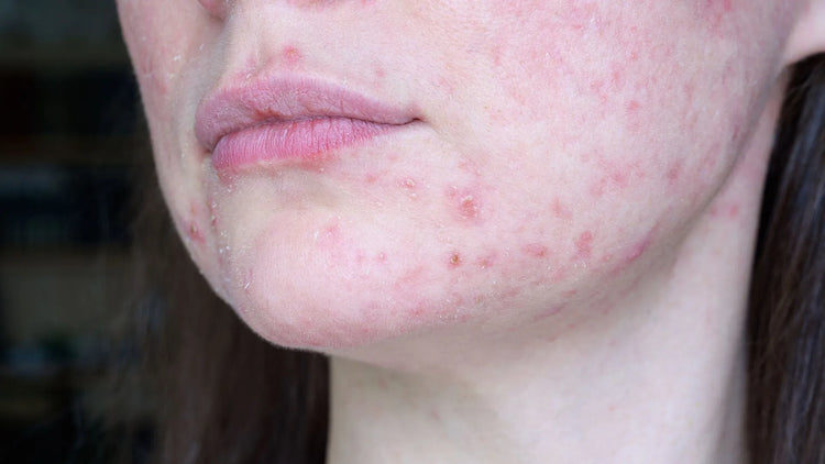 Understanding and Treating Post-Inflammatory Erythema: A Comprehensive ...