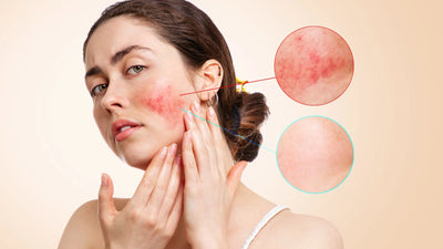 How Can I Take Care of My Sensitive Skin?