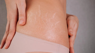 Can Stretch Marks Go Away When You Lose Weight?