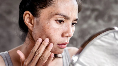 What You Need to Know About Melasma Laser Treatment