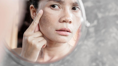 What is melasma and how can you manage it?