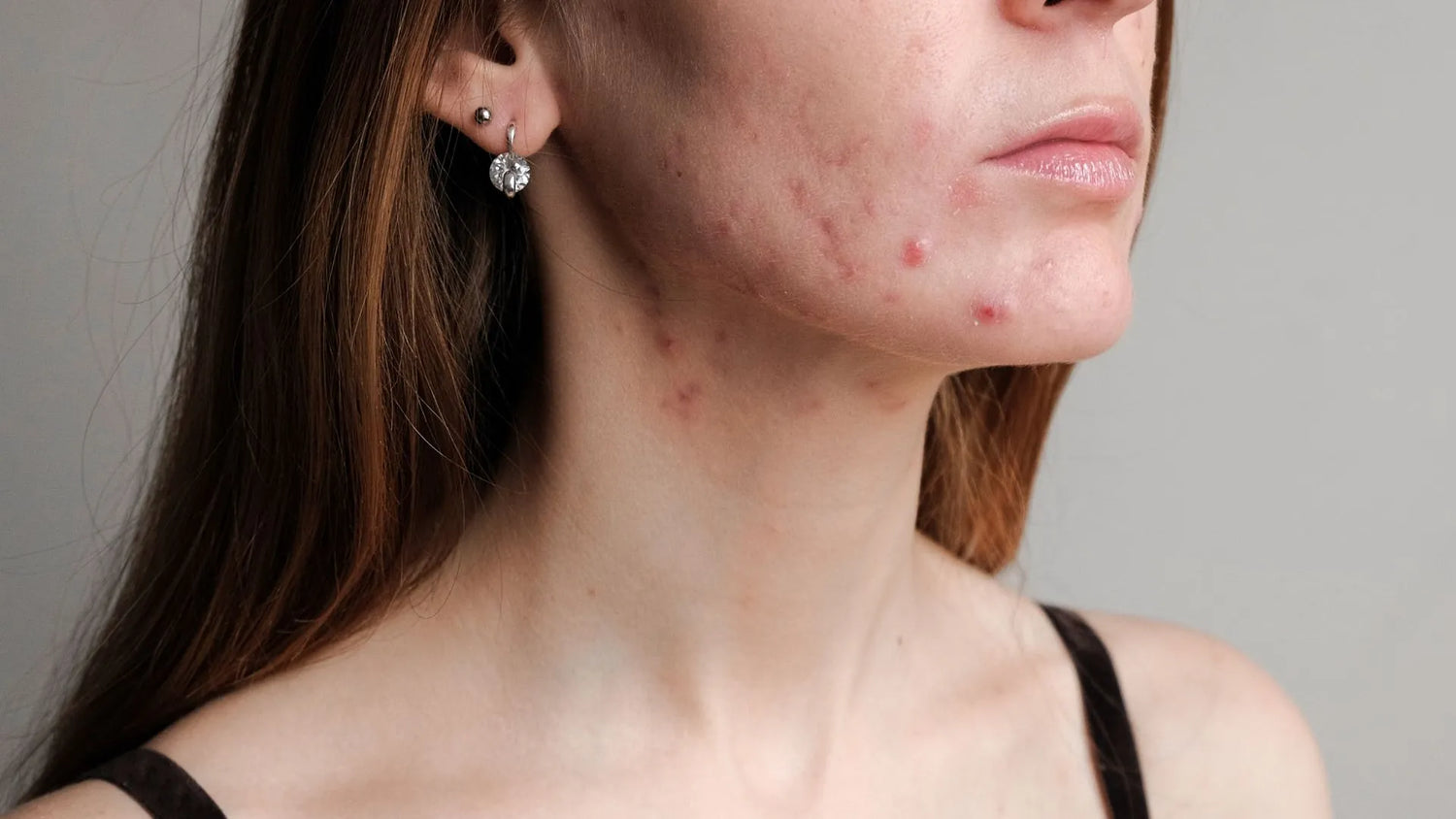 Effective Acne Treatment: Using Glycolic Acid for Clearer Skin