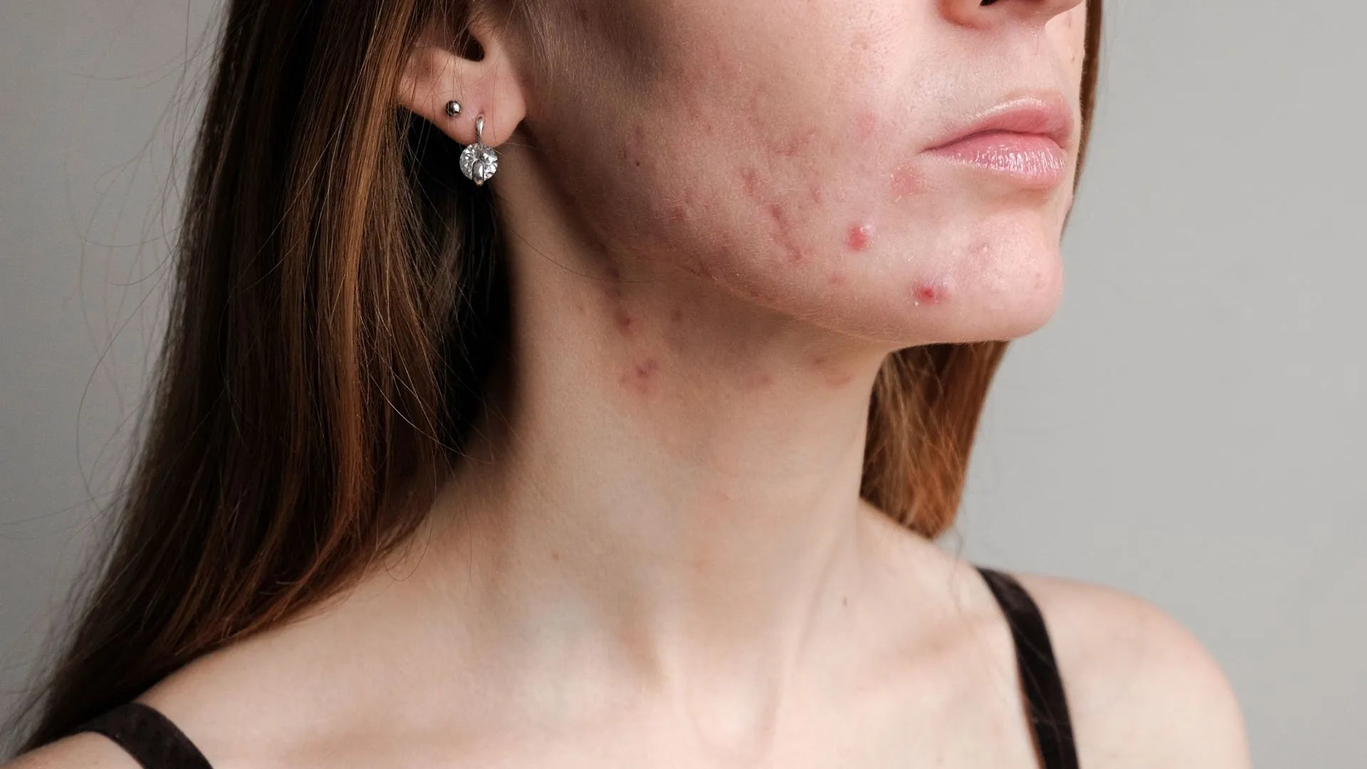 Effective Acne Treatment: Using Glycolic Acid for Clearer Skin