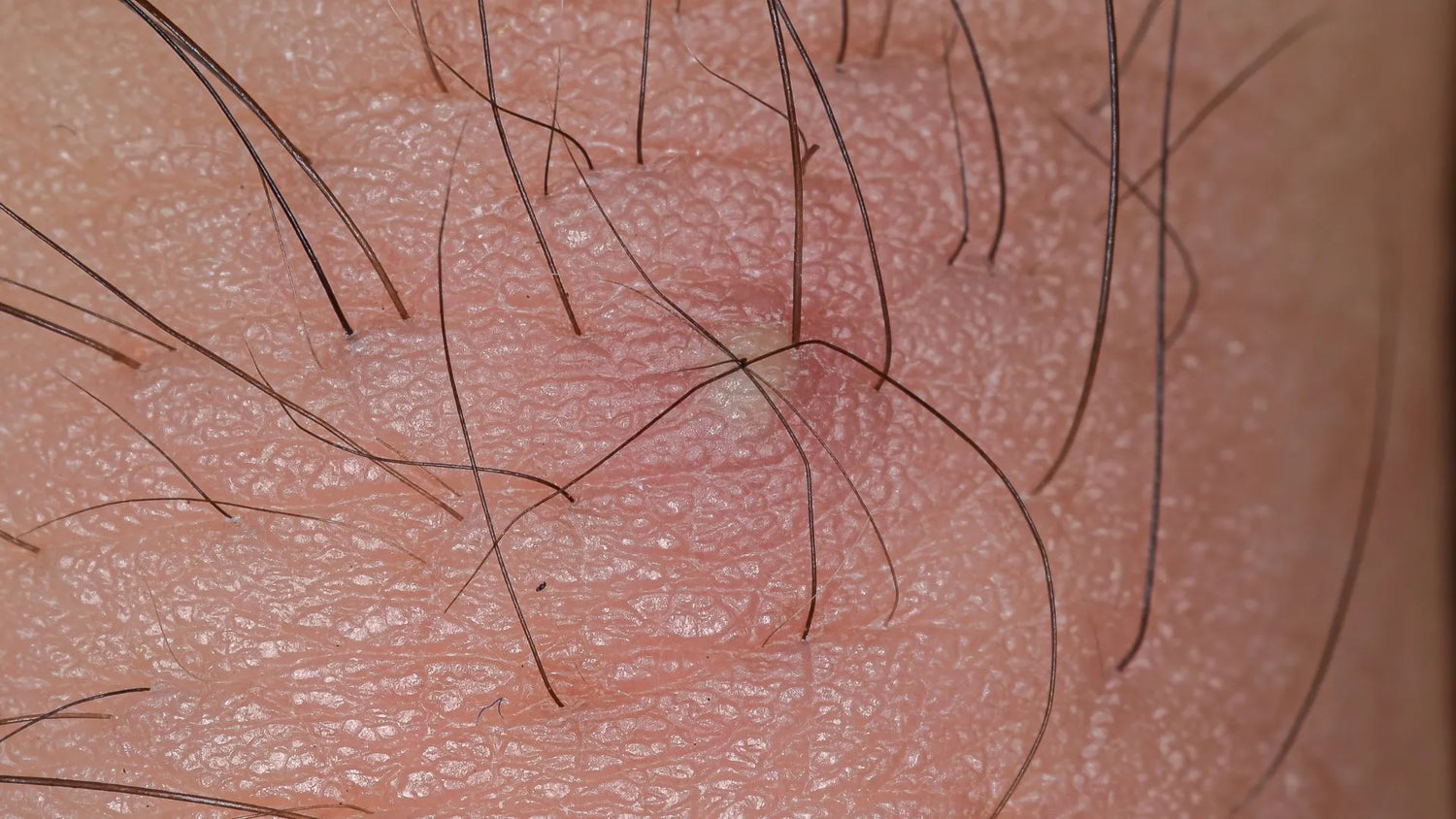 Glycolic Acid: The Ultimate Solution for Bikini Line Ingrown Hairs