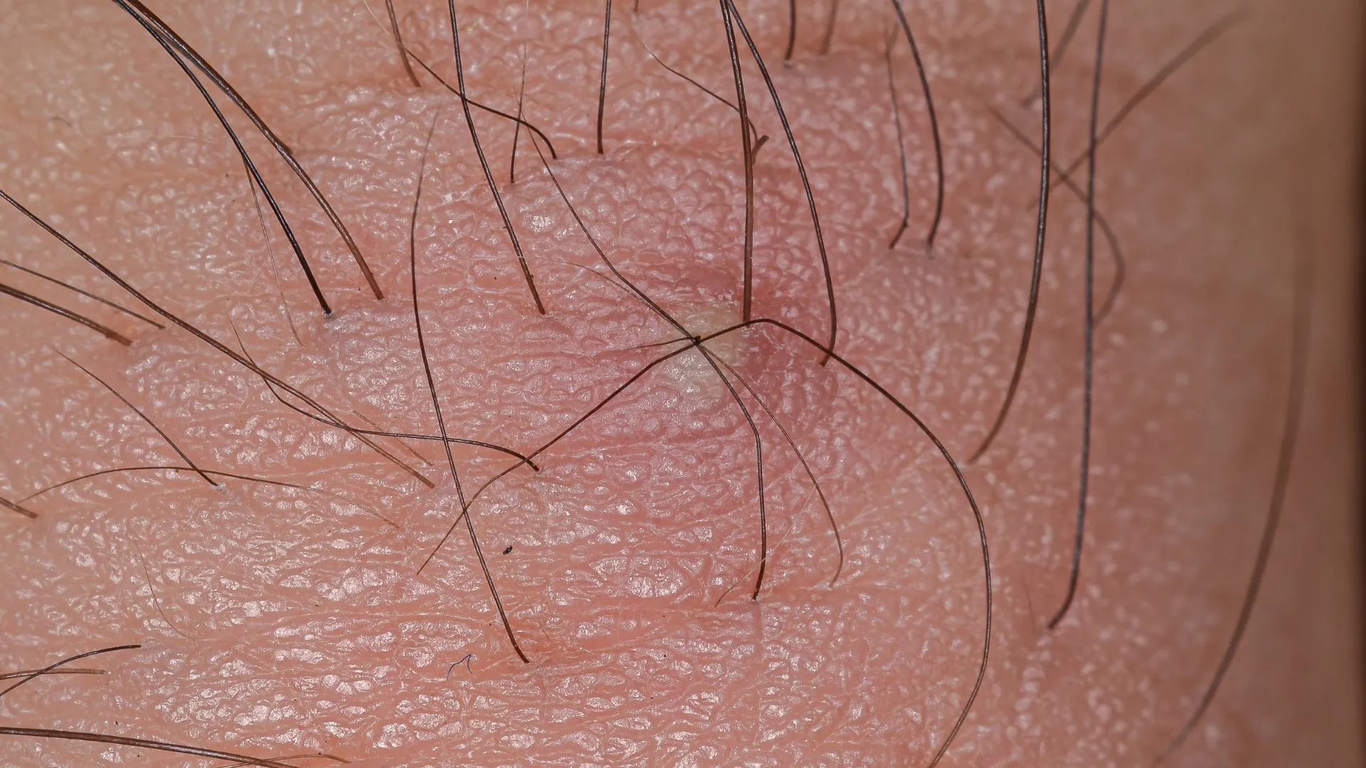 Glycolic Acid: The Ultimate Solution for Bikini Line Ingrown Hairs