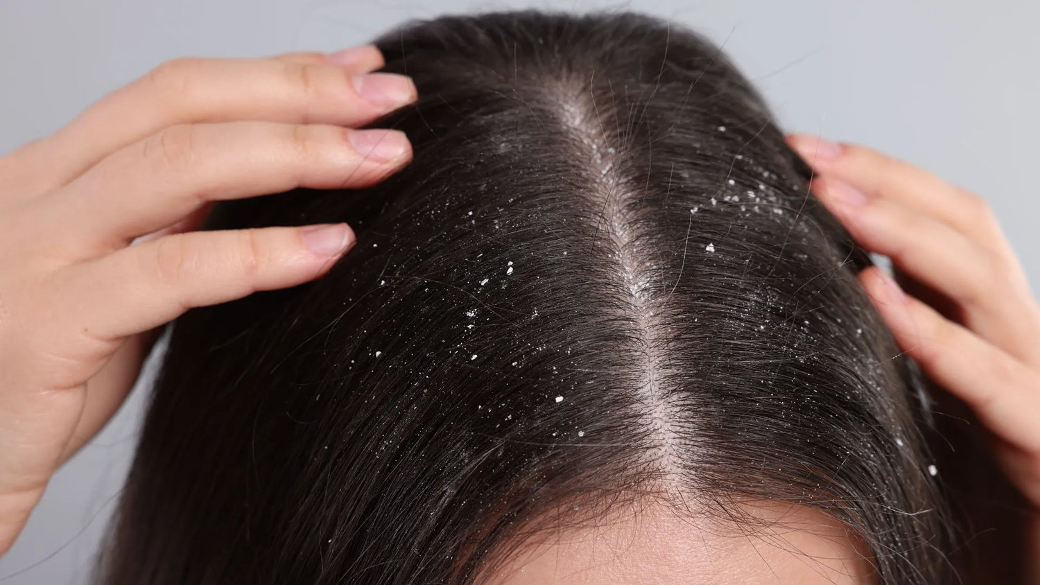 Glycolic Acid's Efficacy for Dandruff Treatment Explored