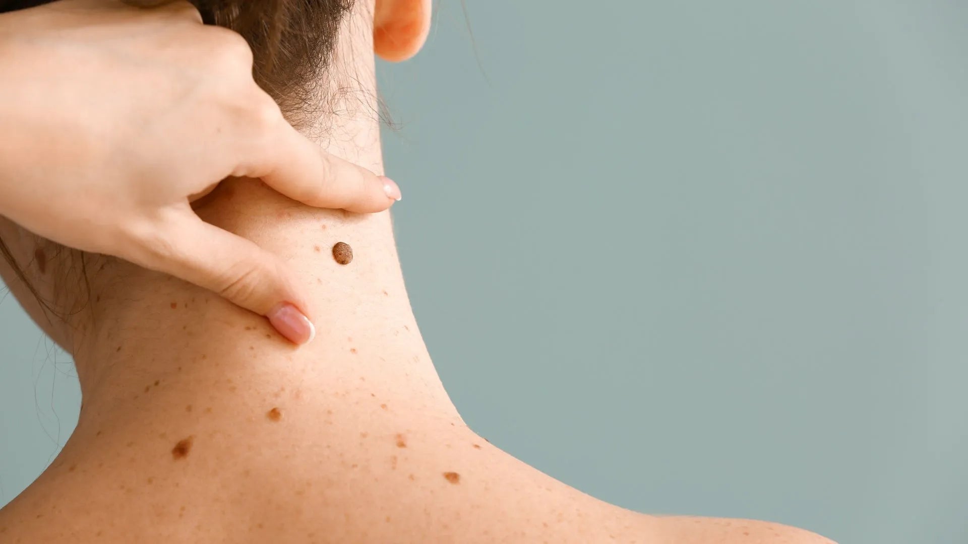 Moles vs Beauty Marks Understanding the Difference and Embracing Your