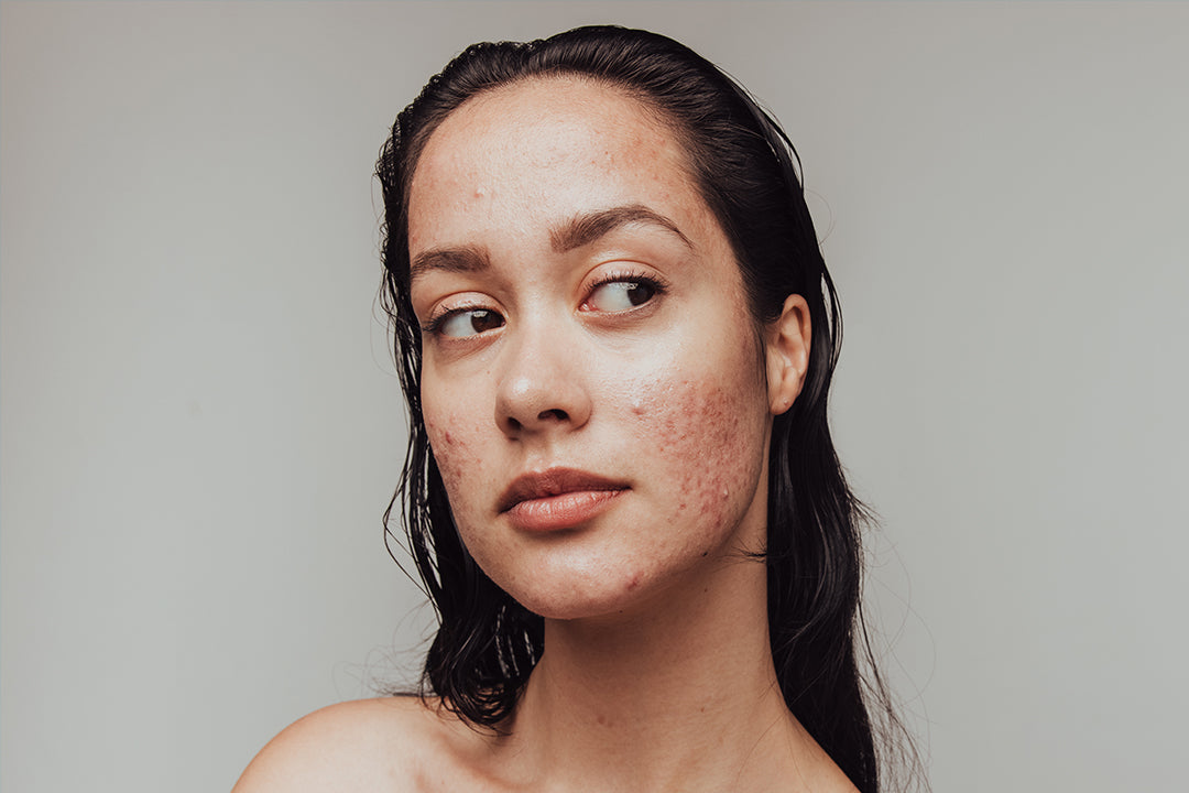 Skincare Myths: Is Acne Only a Teen Issue?