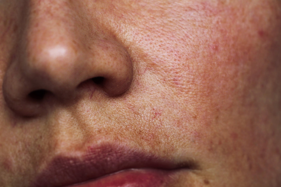 How to Identify and Care for Sensitive Skin