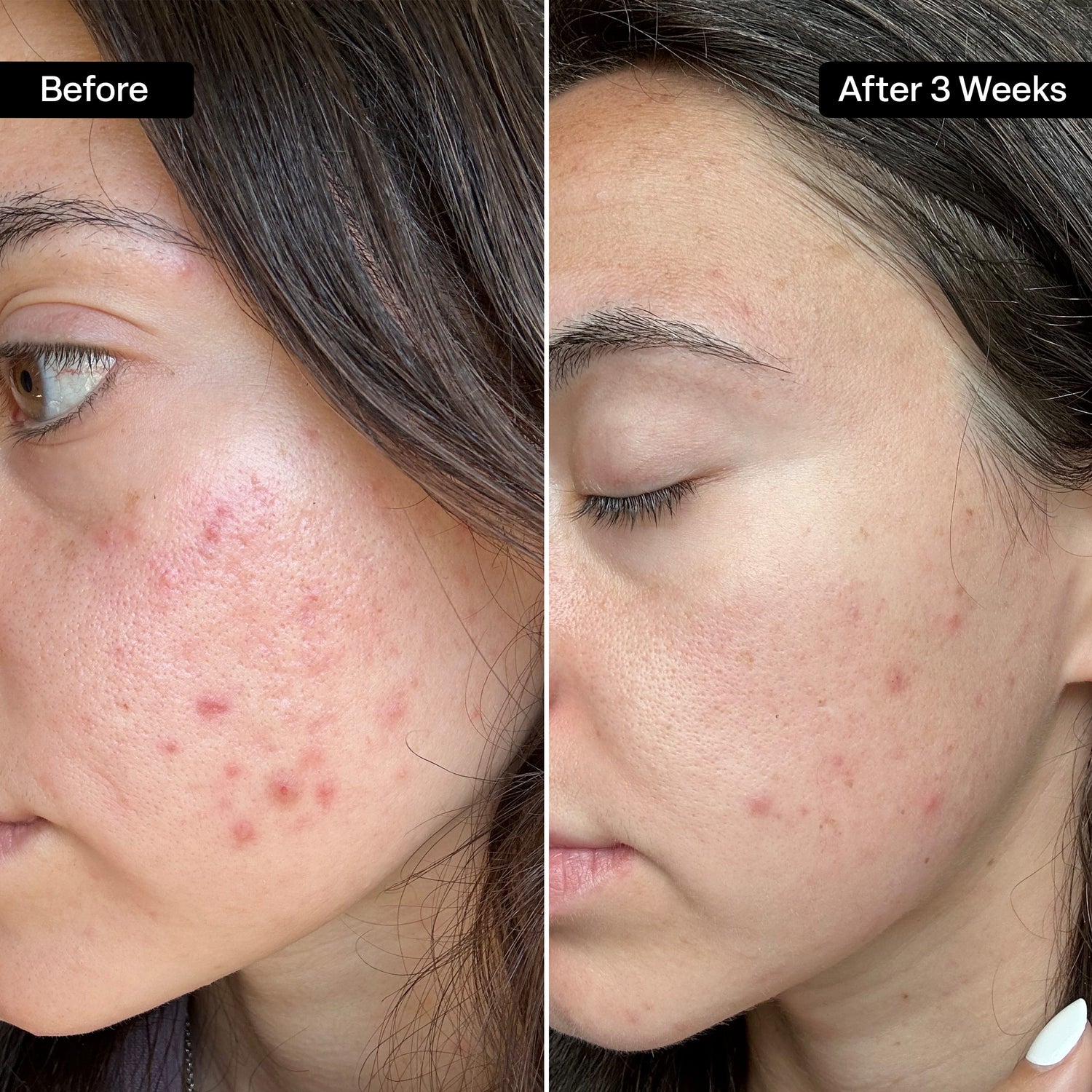 10/2 Glycolic/Salicylic Acid Acne Pads